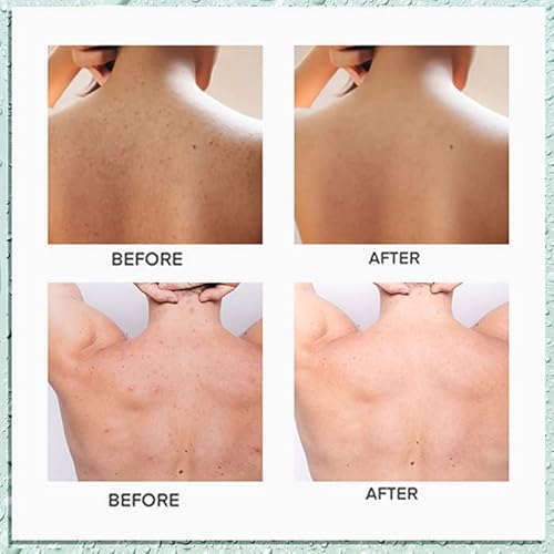 Back Acne Treatment, 2% Salicylic Acid Body Acne Treatment With Herbal Formula, Tea Tree Oil Acne Treatment For Teens, Back Acne Solution, 4.05 Ounce #TOP1