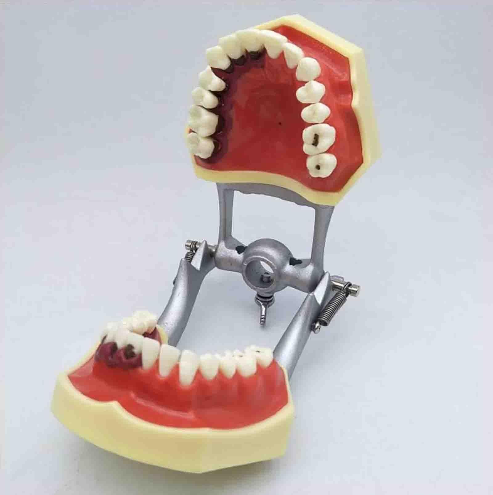 Model patologii przyzębia – kamień nazębny | Model dentystyczny typu typodont – zęby wkręcane – metalowy uchwyt