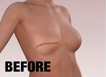 TuckTats Lily Temporary Tattoo for Scars Realistic Waterproof Scar Cover Tattoo for Mastectomy, Reconstruction & Top Surgery Floral Design, Long Lasting 57 Days