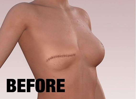 TuckTats Lily Temporary Tattoo for Scars Realistic Waterproof Scar Cover Tattoo for Mastectomy, Reconstruction & Top Surgery Floral Design, Long Lasting 57 Days