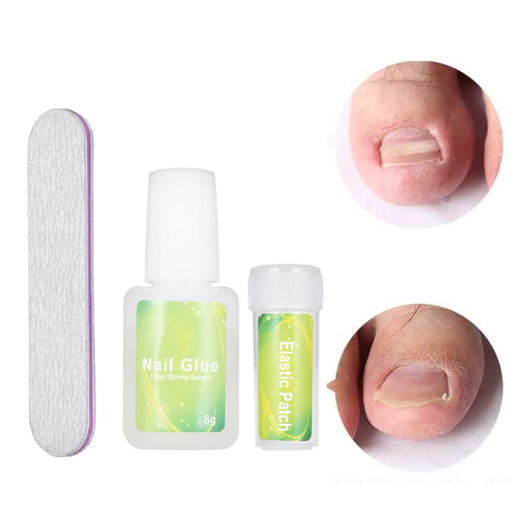 Kit di correzione della patch di unghie dei piedi incarniti elastico patch per chiodi con glu -correzione della file unghie