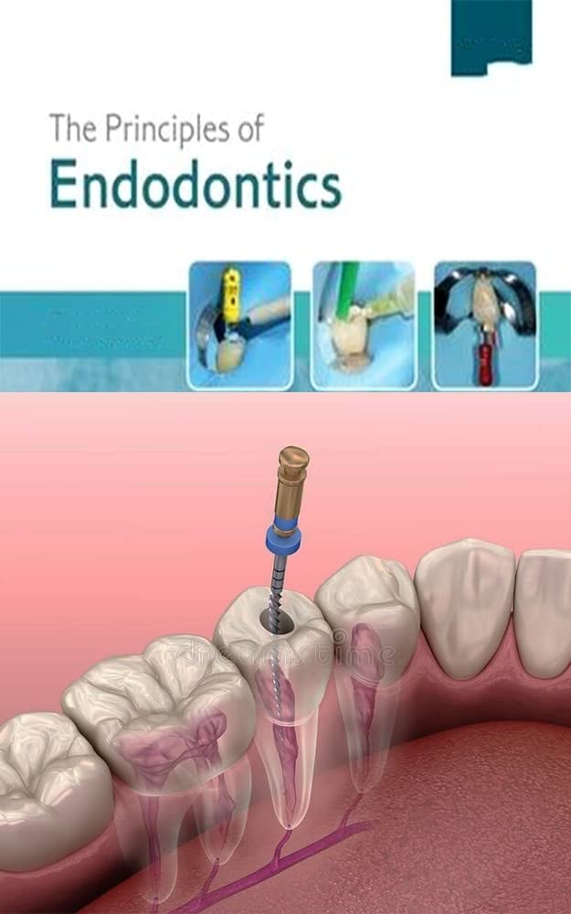 endodontic mishaps ,cause of failure , detection , correction