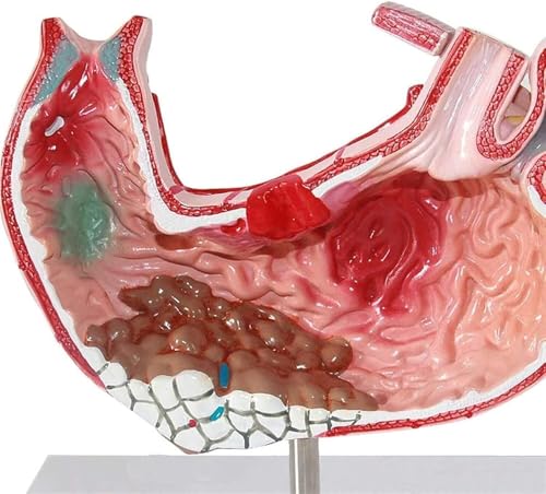 Modèles médicaux d'ulcère gastrique pour simplifier les diagnostics - 3