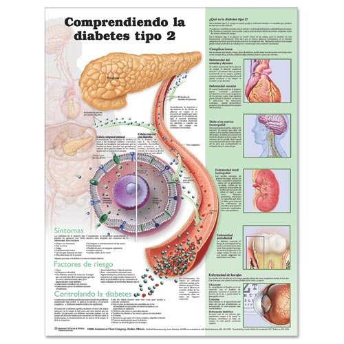 Buy Understanding Type 2 Diabetes Anatomical Chart in Spanish