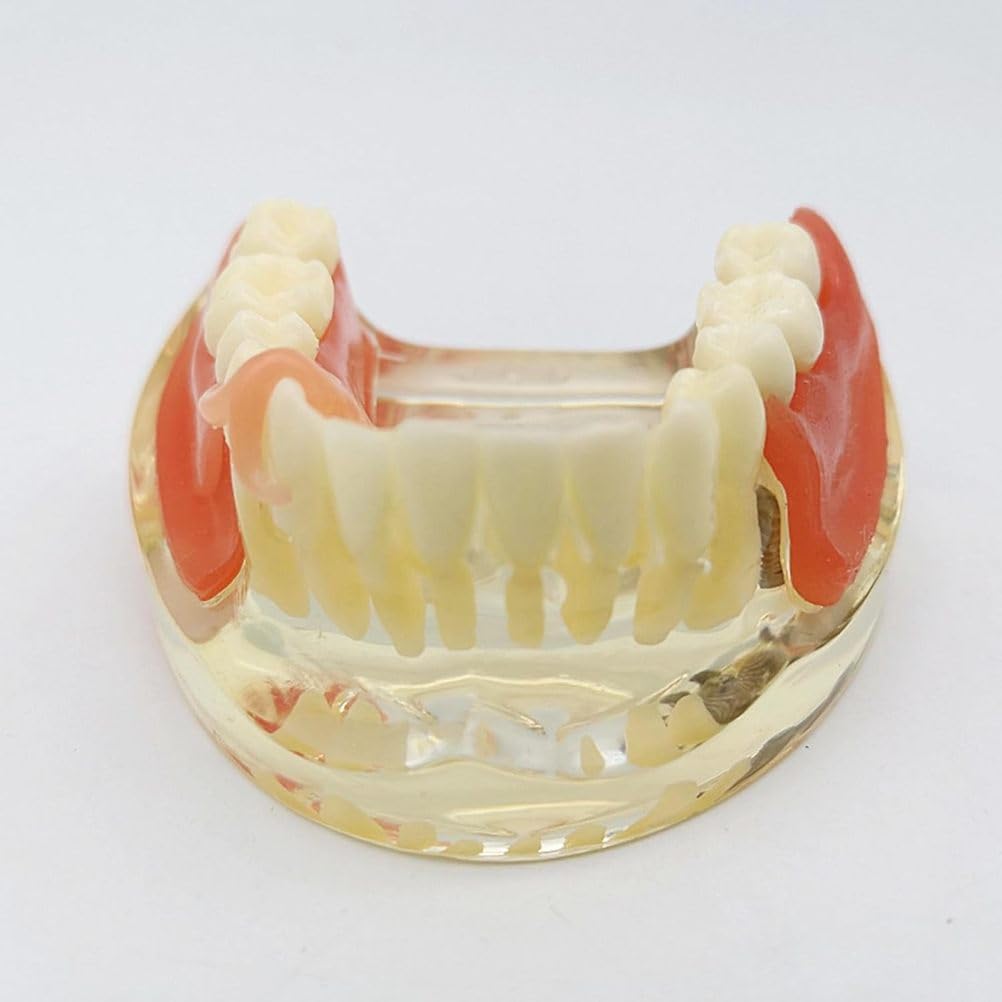 Implant-Supported Restorations Comparison Model Transparent Dental Implant Model Education Study
