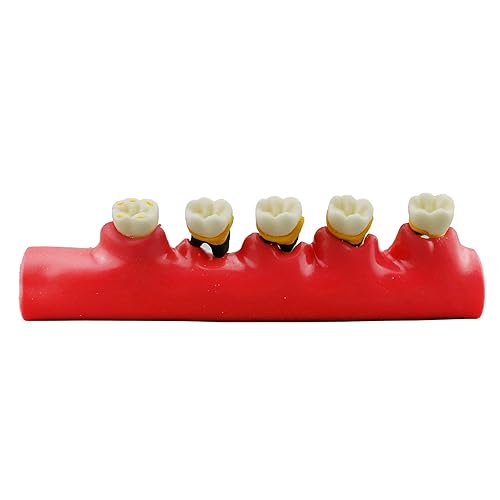 Miniatura 3 de Dientes Modelo de enfermedad periodontal Caries Dental Desglose Display Periodontitis Mostrar enseñanza Modelo de diente Dentista Odontologia