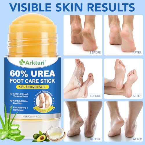 Urea Cream, Maximum Strength Urea Foot Cream, 60% Urea Cream Stick plus 2% Salicylic Acid Callus Remover for Dry Cracked Heels, Hands, Knees, Exfoliating Moisturizer, Dead Skin Remover Foot Balm 1.4OZ - Image 3