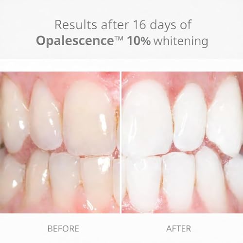 Miniatura 2 de Opalescence Jeringas de gel 10% blanqueamiento dental - Kit de recarga (4 jeringas en total) peróxido de carbamida. Fabricado por Ultradent, en