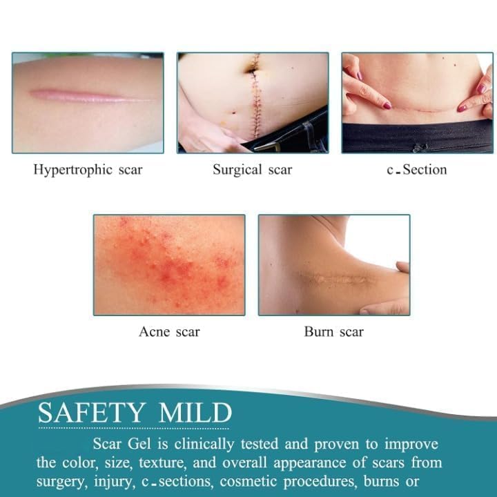 Image of Silicone Scar Removal Tape (1.5M Roll) Medical Grade Reusable Scar Reduction Sheets For Surgical, Handmade , BPA Free,C-Section, Acne, Burn & Keloid Scars Soft & Breathable Skin Tape EQUSUPRO (Silicone Scar Sheets)