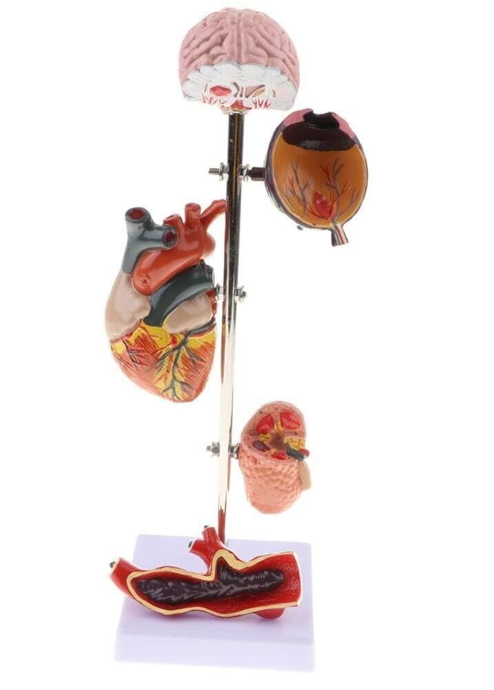 Modèle de pathologie diabète et hypertension avec 5 organes amovibles