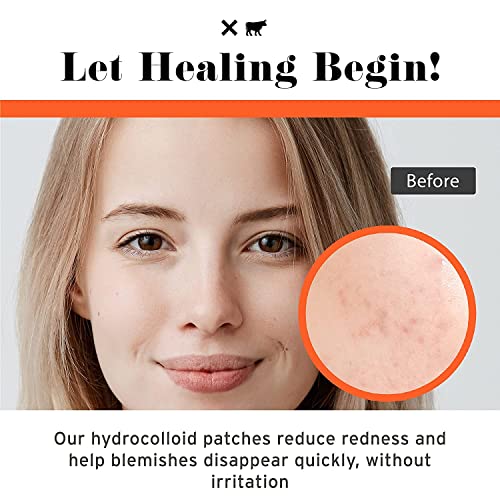 No BS Healing Acne Patches - Hydrocolloid, Acne Spot and Pimple Treatment to Prevent Acne Scars. Invisible On All Skin Tones (1 BOX of 72ct)