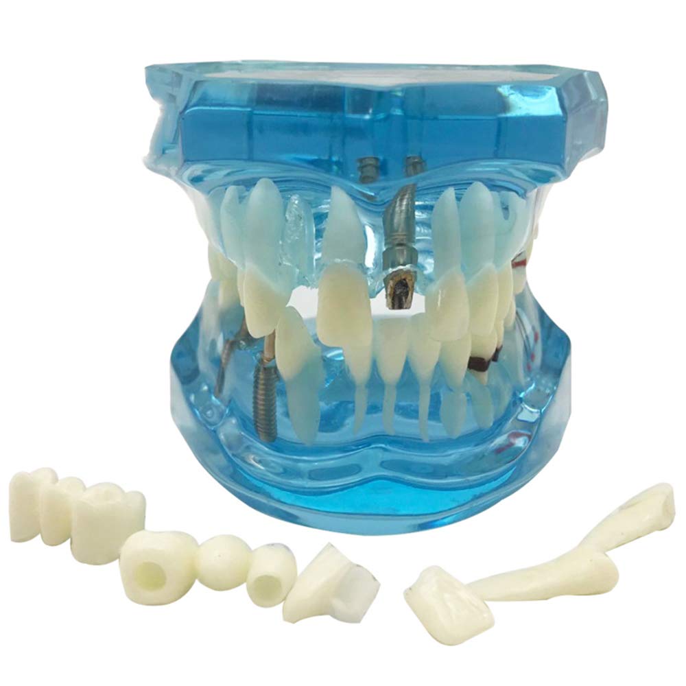 Sjdopulse A Pathologies Teeth Model - Teeth Teaching Model - Transparent Dental Teeth Study Teaching Model Dult Pathology Model - Removable Tooth Model - For Study Teaching (A)