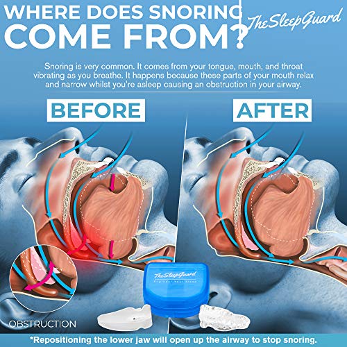 image for TheSleepGuard | Stop Snoring Mouth Guard | Anti Snoring Aid, Device Ai
