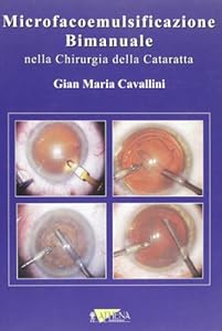 Vedi scheda su Amazon Microfacoemulsificazione bimanuale nella chirurgia della cataratta