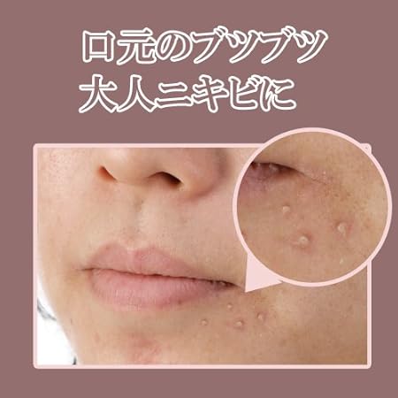 Amazon 口周りの白いポツポツに シロトリンb イザヴェル ビューティー 通販 Amazon 口周りの白いポツポツに シロトリンb イザヴェル ビューティー 通販