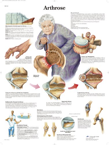 3B Scientific Lehrtafel laminiert - Arthrose