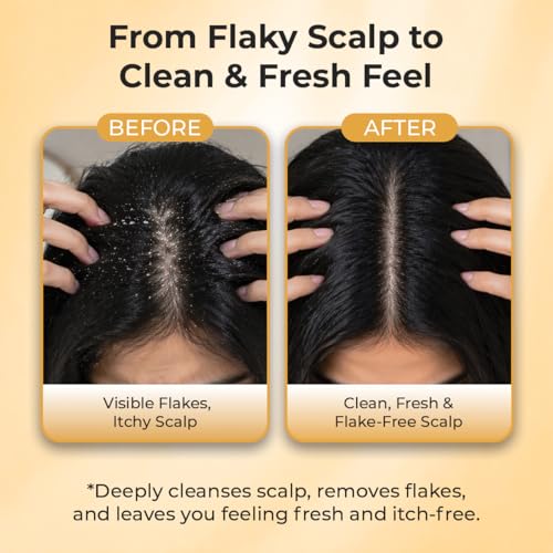 Image of Sanfe Dandruff Care Advanced Scalp Cleaning Comb For Healthy Scalp | 1 Unit