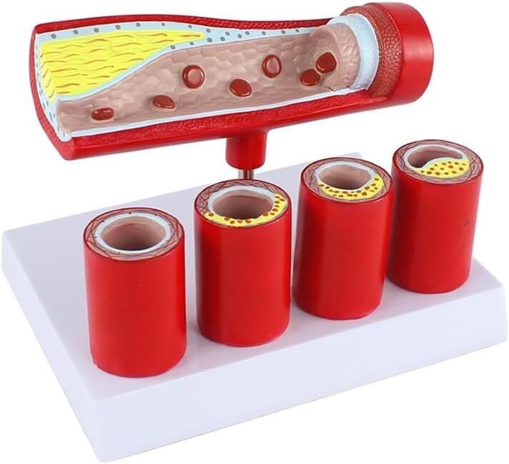 Cardiovascular Artery Coronary Artery Model Teaching pathological Blood Vessel Model, Suitable for Doctors' Offices and classrooms, Medical Learning Resources