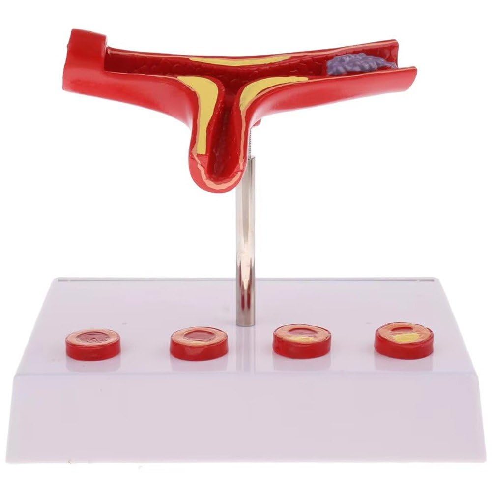 Ppmter Human Atherosclerosis Cardiovascular Model Blood Vessel Anatomical Model Medical Teaching Supplies