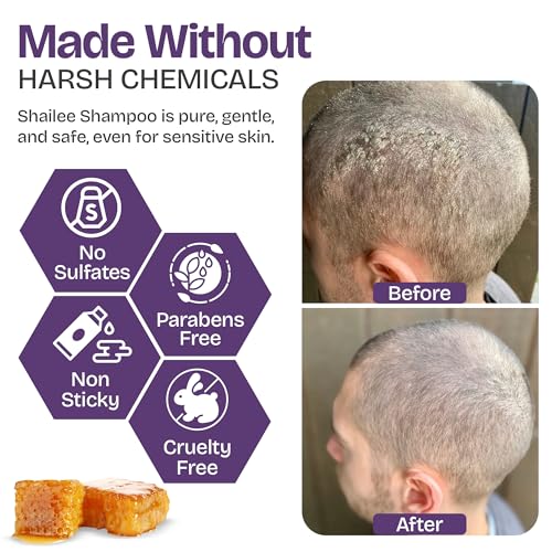 Image of Psoriasis Shampoo for Eczema, and Folliculitis Treatment - Seborrheic Dermatitis Antifungal Shampoo for Ringworm, Acne, Flaking, Dry & Itchy Scalp Treatment - Psoriasis Relief with Manuka Honey