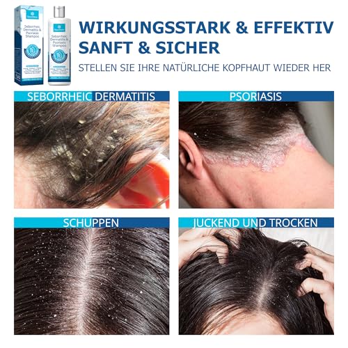 RoyceDerm Seborrhoisches Schuppenflechte Kopfhaut Shampoo: Neurodermatitis Anti-Schuppen Kopfhaut Shampoo bei kopfhaut & Körper - Seborrheic Dermatitis Schuppenflechte Shampoo