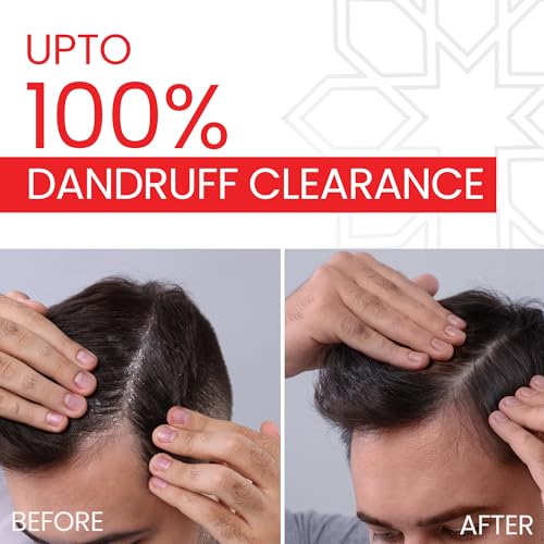 Image of LUPIZOL-ZS Anti Dandruff Shampoo, Reduces Dandruff Upto 100% and Scalp Irritation, Strengthens and Softens Hair, With Luliconazole, Dermatologically Tested, All Hair Types, For Men and Women, 100ml.
