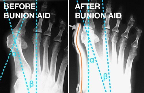 Vroxy Silicone Gel Orthotic Toe and Finger Separator Cushion Foot Care | Bunion Correction Toe Separator 2