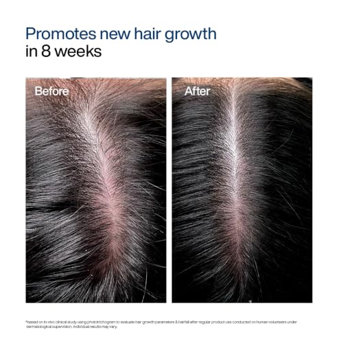 Image of WishCare Hair Growth Serum Roll On For Scalp | 94% Saw New Hair Growth | Redensyl & Rosemary Oil | 100% Saw Hairfall Reduction | In-Vivo Tested | For Men & Women | 30ml