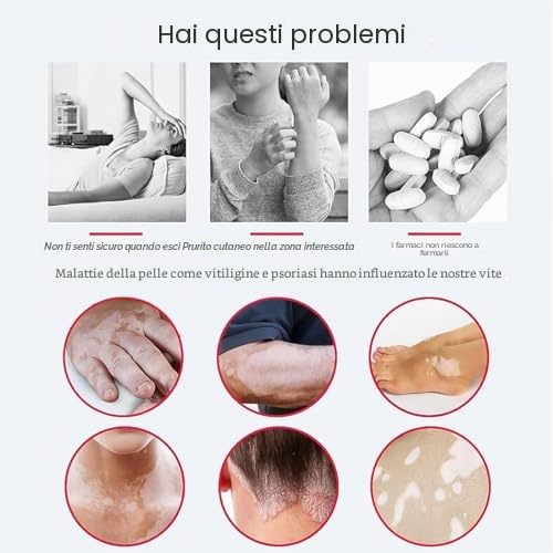 Lampada portatile per fototerapia, 311 nm, dispositivo di trattamento UVB a banda stretta per disturbi della pelle, soluzione portatile per la cura della pelle per corpo e cuoio capelluto