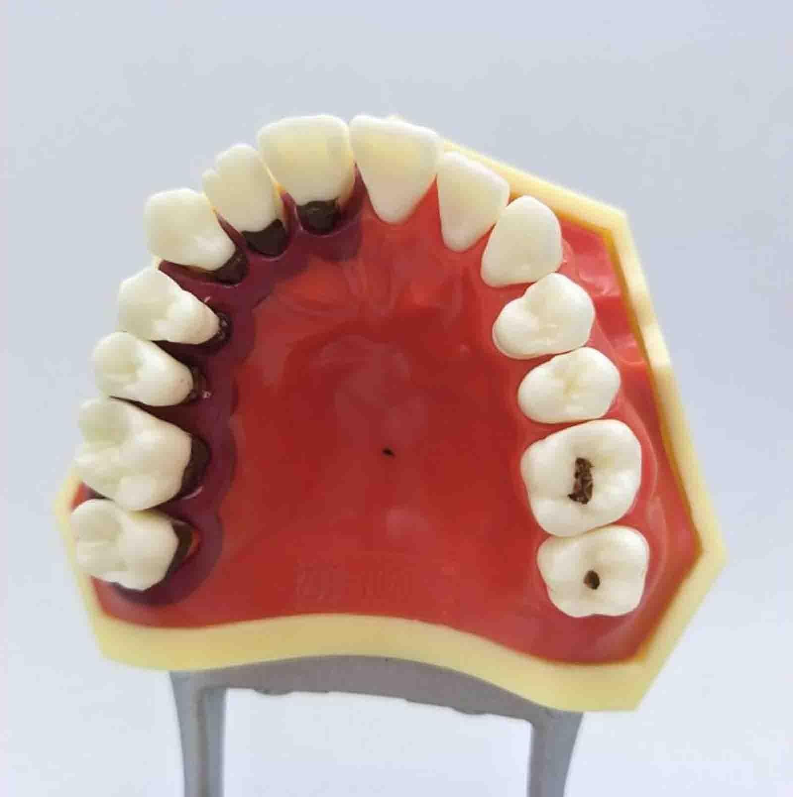Model patologii przyzębia – kamień nazębny | Model dentystyczny typu typodont – zęby wkręcane – metalowy uchwyt