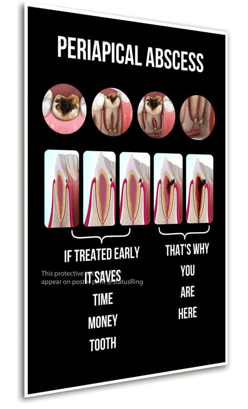 Caries to periapical bk abscess Dentist dental clinic poster StatusRing without frame-picture-17