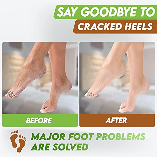 Karma Organic Foot Peel Mask Coconut Moisturizing Exfoliating Foot Masks Feet Peeling Masks For Dry Cracked Feet thumb #6