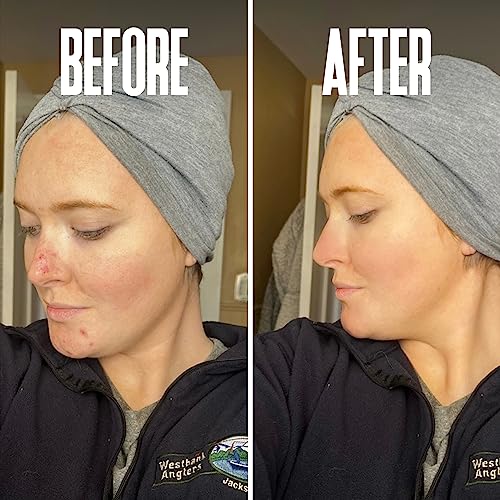 Divine Derriere Glycolic Acid Peel 40% Professional Chemical Peel For Face For Acne Scars thumb #6