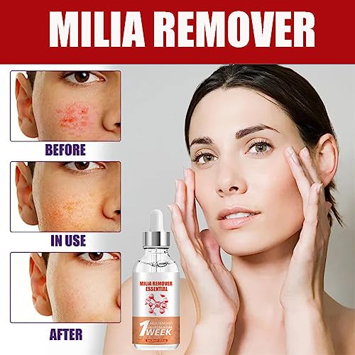 Milia Remover, Milia Spot Serum for Face Milia Spot Removal Helps to Ruduce Milia, Dark Circles Under Eye for Women & Men - Image 3