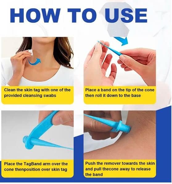 Image of Skin Tag Remover Set, Skin Tag Remover Kit 2 in 1, Skin Tag Removal Kit with Rubber Bands Rings for Removing Small to Medium