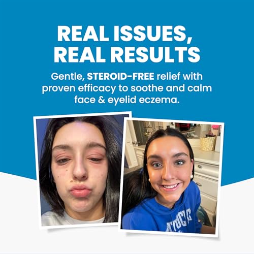 Image of Grahams Natural Face & Eyelid Eczema Cream - Treatment for Eczema, Dermatitis, Itch Relief, Redness, Inflammation & Very Dry Skin - with Colloidal Oatmeal - Hypoallergenic & Steroid-Free (1 x 50g)