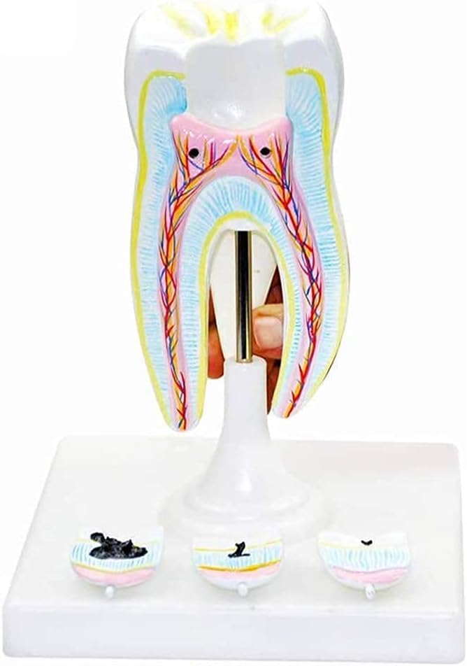 ERNZI Modèle Dentaire, Démonstration Biomédicale Enseignement De Anatomie des Dents Humaines, Modèle De Carie Dentaire Molaire, Modèle Enseignement Standard pour Adultes