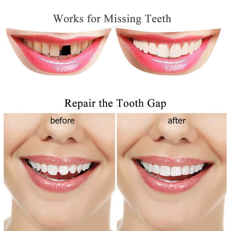 DIY Cosmetic Teeth Repair 10g – Temporary Moldable Dental Kit - Image 7 thumbnail