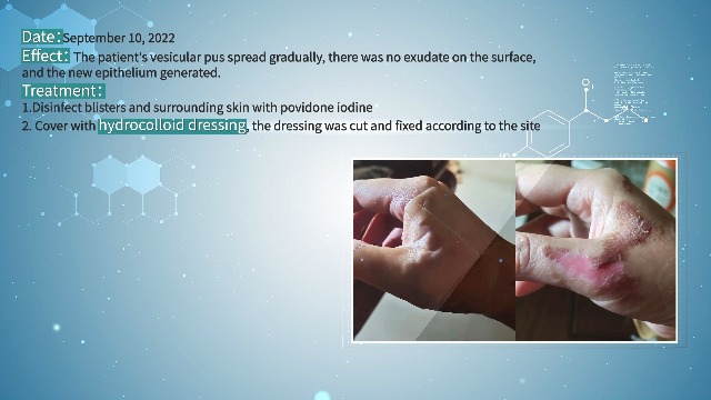 Image of Dimora 20 Pack Hydrocolloid Wound Dressing, Ultra Thin 4 inch x 4 inch Large Patch Bandages with Self-Adhesive