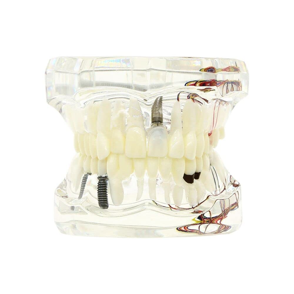 Dental Implant Neural Repair Pathological Implant Disease