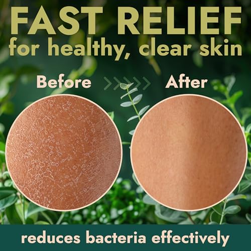 Image of Antibacterial Body Wash for Back Acne, Body Odor & Skin Irritation 16 oz