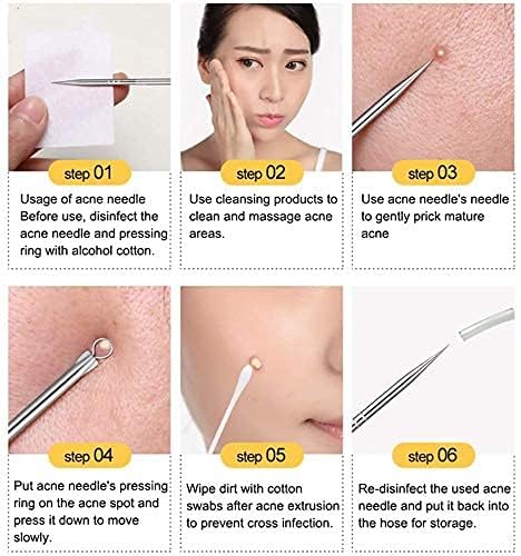 Image of 4Pcs Blackhead Pimple Remover Tools for Professional Tweezers Kit for Remove Acne Comedone Extractor, Black Heads Removing on Face Removal