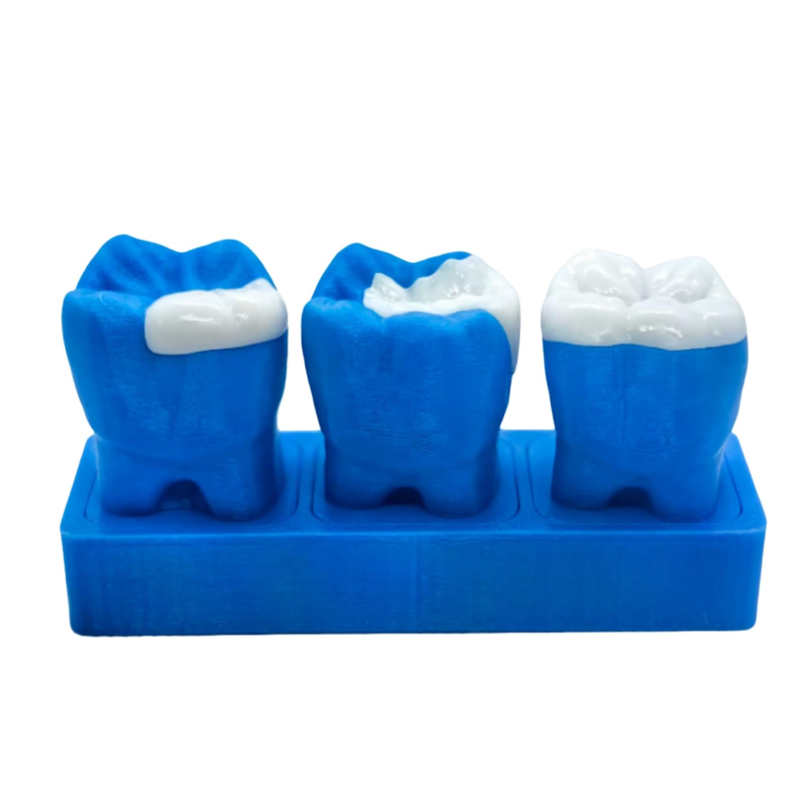 YRQMGSF 6X Teeth Model Inlay Display Model,Dental Teeth Care Model,Dentistry, High Inlays, Gifts for Dentists,Blue