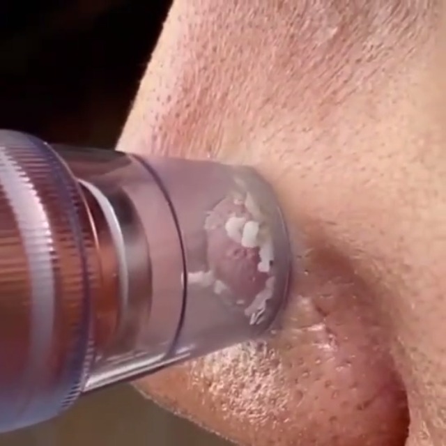 Amazon.com: Extractor de poros para eliminar puntos negros, aspiradora de  poros para cara, limpiador de acné facial eléctrico, aspirador de succión.  El dispositivo es recargable y con 6 sondas, 3 niveles de