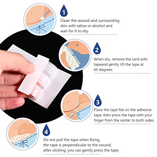 ARTIBETTER 6 PeÃ§as de Fechamento de Ferida Com Adesivo de Pele para RemoÃ§Ã£o de Cicatriz Adesivo d