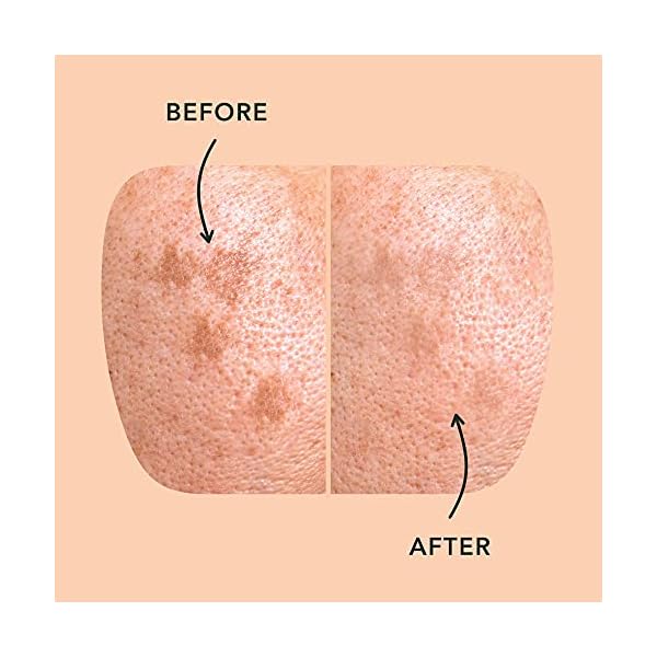 Rael-Microcrystal-Dark-Spot-Cover-Post-Acne-Spots-Skin-Tone-Treatment-Reduce-Redness-with-Skin-Brightening-Ingredients-6-Count Rael Pimple Patches, Miracle Microcrystal Spot Cover - Dark Spot Corrector, Hydrocolloid, Post Acne, with Skin Brightening, for All Skin Types, Vegan, Cruelty Free (6 Count)