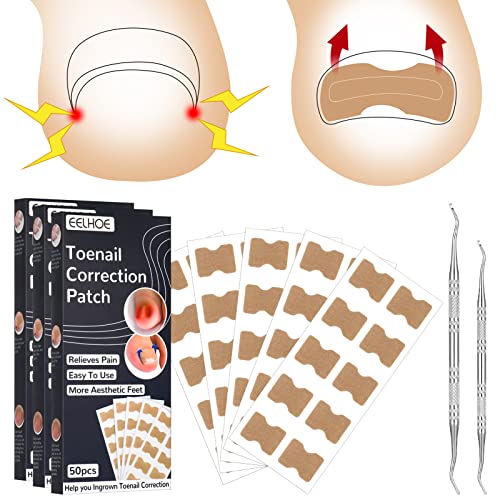 FANTESI 152 Pieces Ingrown Toenail Corrector Sets, Include 150 pcs Toenail Correction Patch Toe Correction Sticker Glue-Free Nail Corrector Patch and 2 pcs Toenail Planing Tool