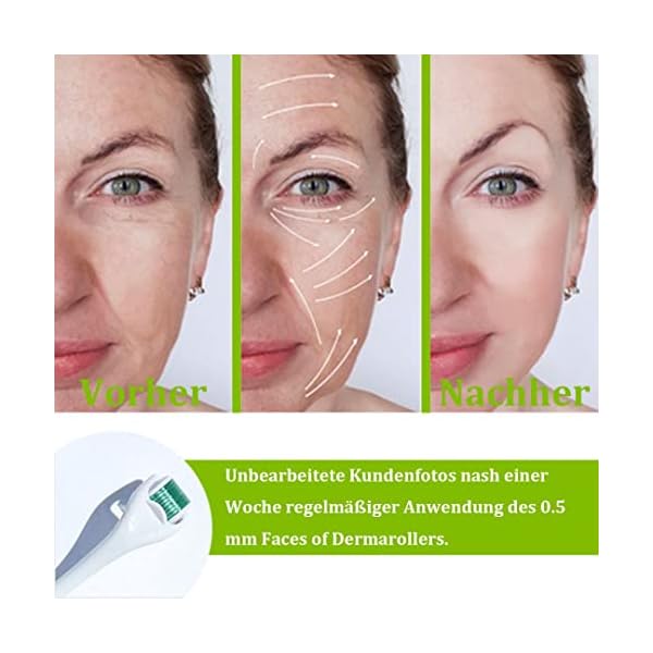 DermaRoller Microneedling Roller mit 540 Nadeln, Micronadeln Derma Roller 0,5 mm für Gesicht und Körper, effektiv gegen Falten, große Poren, Dehnungsstreifen, Haarverlust, Narben, Hyper-Pigmentierung – Bild 3