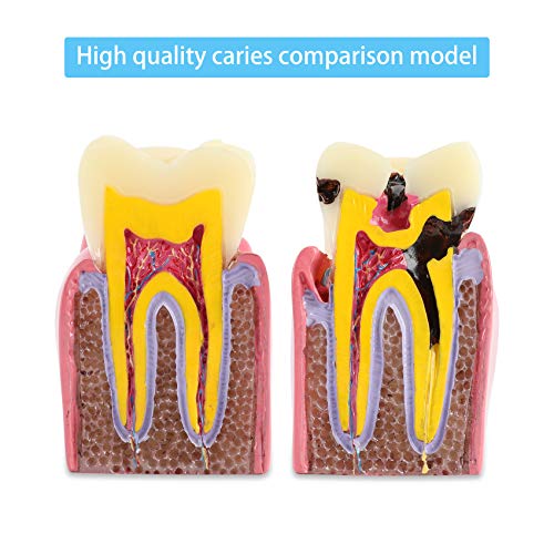 Dental Caries Tooth Model 6 Times Decay Teeth Comparative Study Model, Caries Bilateral Comparison Pathology Teeth Model Teaching Learning Tools For Dentist, Patient Education And Explanation #TOP1