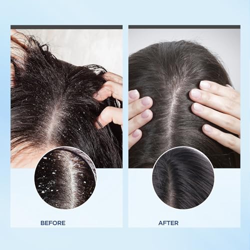 Bablabear Scalp Exfoliator Scrub,Itchy Scalp Treatment For Dandruff,Hair Scrub, No Sulfate Hair Scrub To Soothe A Dry thumb #2